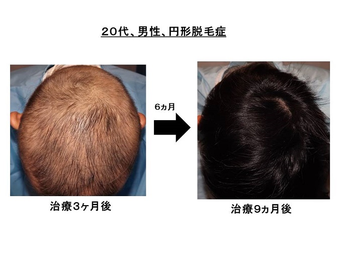 円形脱毛症　病院""